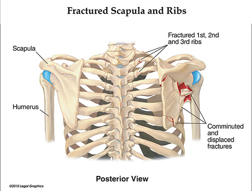 Fractured Scapula and Ribs